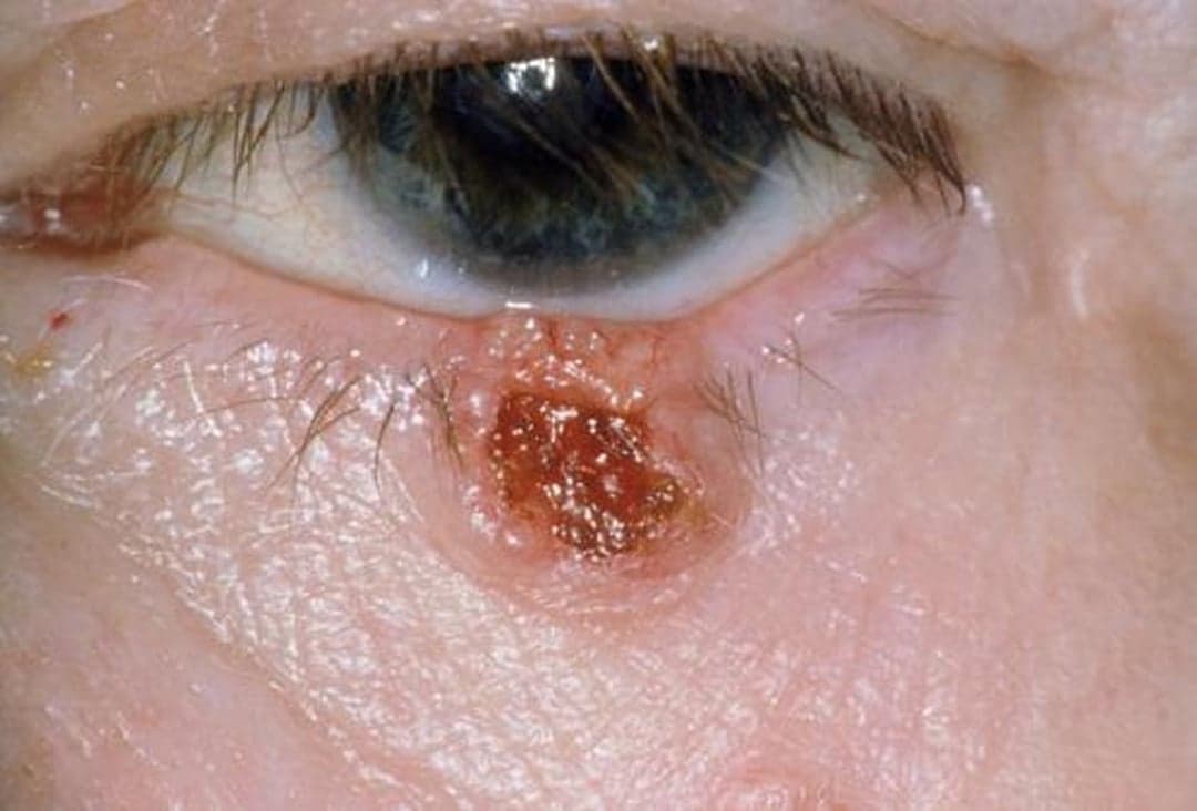 Cirugía palpebral y resección de masas